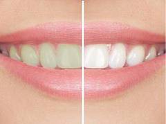 BLANCHIMENT DES DENTS TOULOUSE